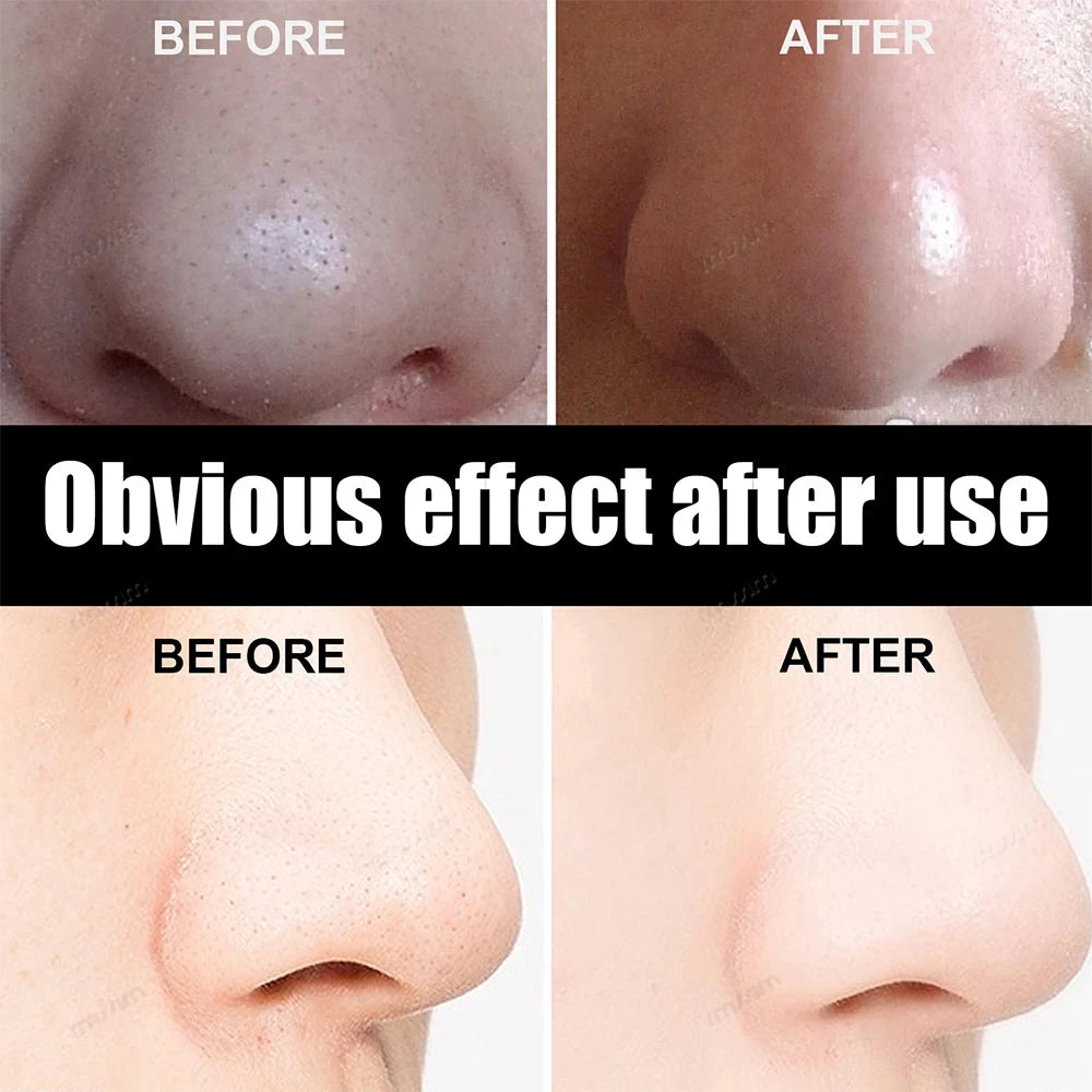 50/100PCS Bamboo Charcoal Nasal Strips Blackhead Remover Mask Acne Pimples Treatment Patch Shrink Pores Nose Stickers Skin Care